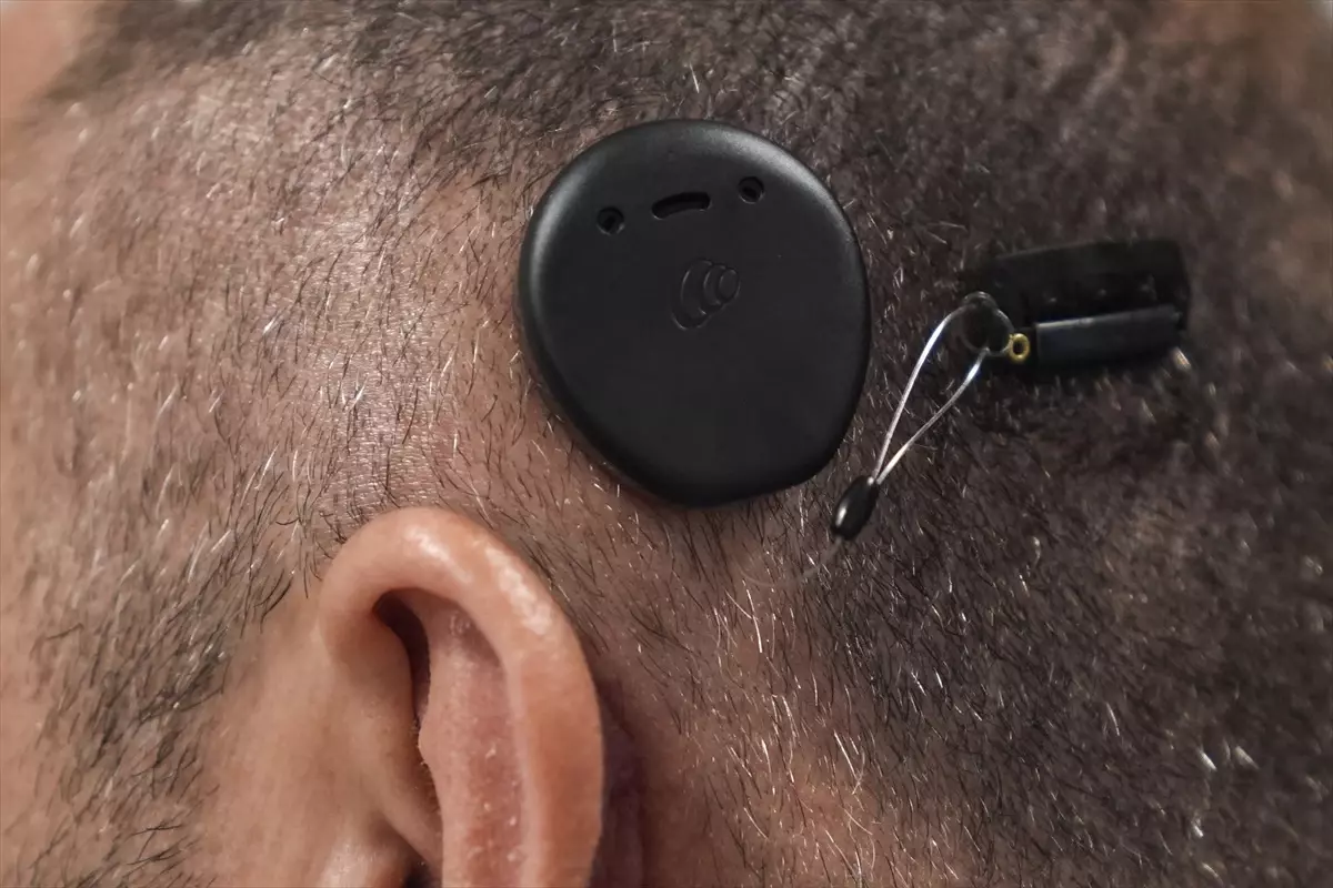 Biyonik Kulakla Yeniden Duyma Mücadelesi