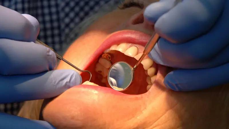 Diş minesini onaran yeni jel: Çürüklerin sonu mu geliyor?